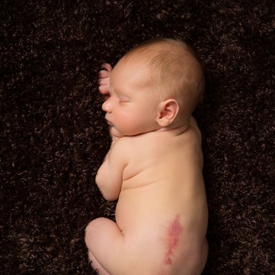 Newborn Boy with Scar from Spina Bifida Surgery